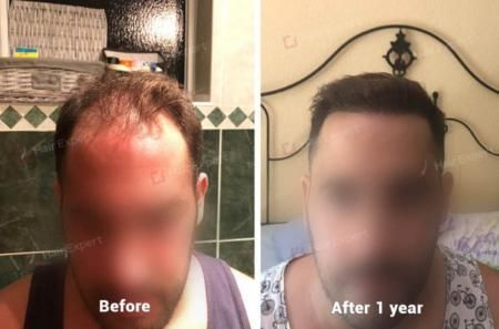 Hair Transplant Case Study in Turkey - 3000 Hair Follicles