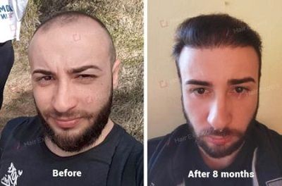 4000 Grafts Hair Transplant Case Study