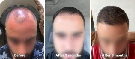 Male Hair Transplant Results - 2633 Grafts