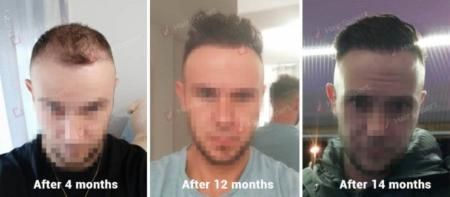 Results Before and After Hair Transplant - 4110 Grafts