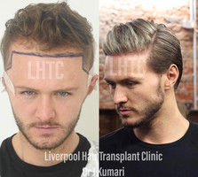 FUE Hair Transplant