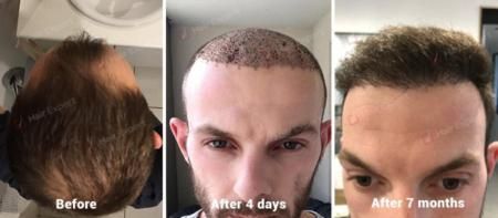 Hair Transplant Case Study - 4195