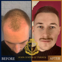 Before and After Results - Hair Center of Turkey