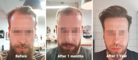 Sapphire Hair Transplant Case Study - 4500 Grafts