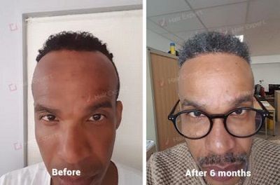 Curly Hair Transplant Results - Sapphire/FUE