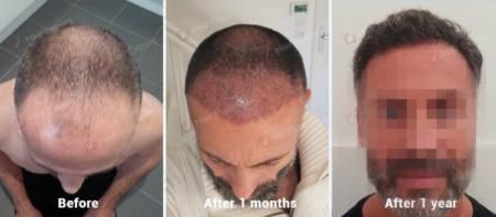 Hair Transplant Result in Istanbul - 3534 Grafts