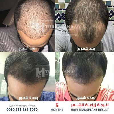 Hair transplant