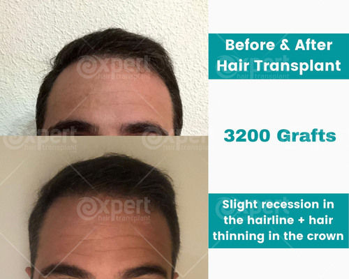 3200 Grafts Hair Transplant Case Study - Expert Hair Transplant