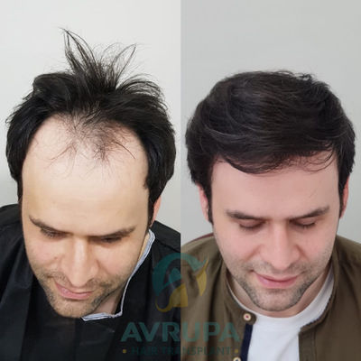 FUE Hair Transplant Results After 9 Months - 4300 Grafts