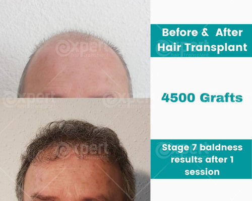 4500 Grafts Hair Transplant Case Study - Expert Hair Transplant