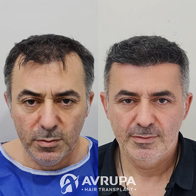 Hair Transplant Results After 9 Months