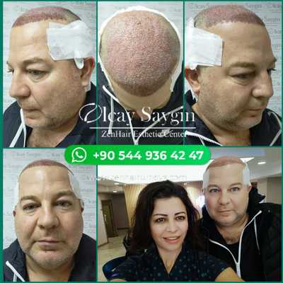 Hair Transplant with  Olcay Saygin Zen Hair Transplant Clinic