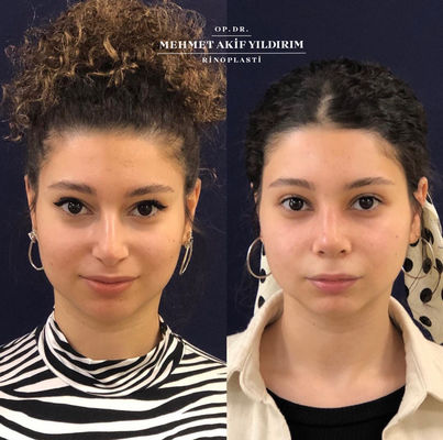 Rhinoplasty Before and After in Turkey