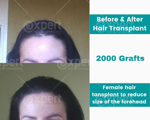 Female Hair Transplant Case Study - Expert Hair Transplant