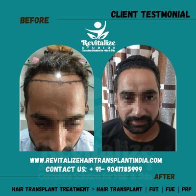 Hair Transplant In Jalandhar