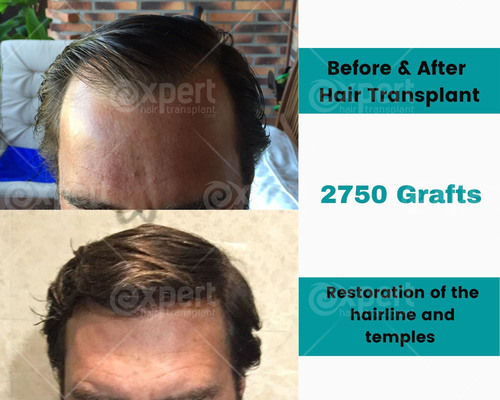 2750 Grafts Hair Transplant Case Study - Expert Hair Transplant
