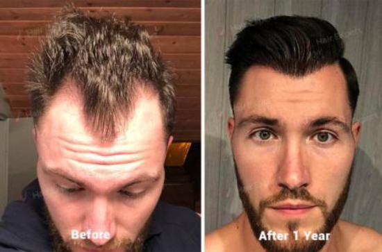 Temples Hair Transplant 2800 Grafts