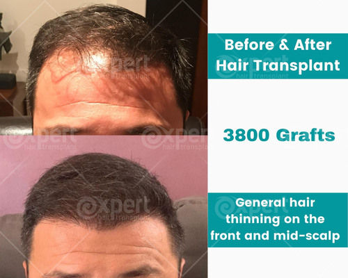 3800 Grafts Hair Transplant Case Study - Expert Hair Transplant