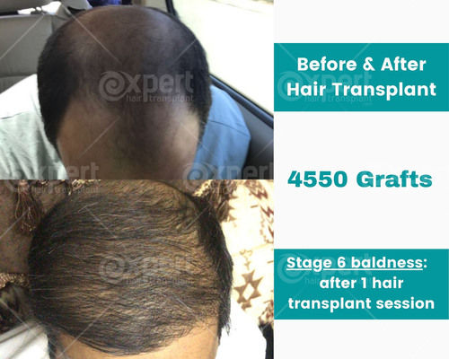 4550 Grafts Hair Transplant Case Study - Expert Hair Transplant