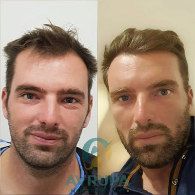 6 Months Post Hair Transplant in Turkey 2020 - 4300 Grafts