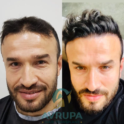Dense Packing Hair Transplant in Turkey with 3200 Grafts