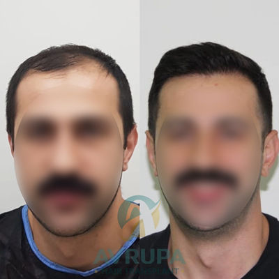 5600 Grafts Hair Transplant Case Study