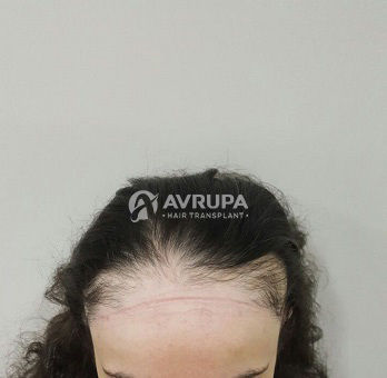 Female Hair Transplant Results - 3750 Grafts