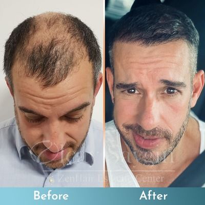 Hair Transplant Results