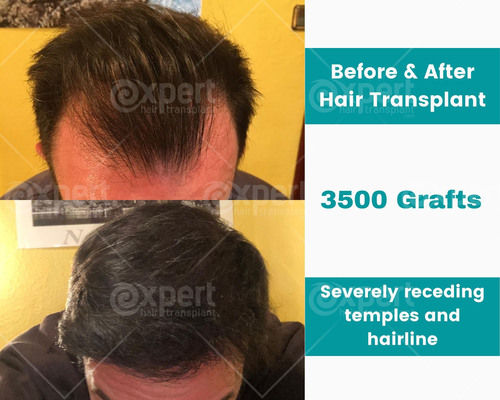 3500 Grafts Hair Transplant Case Study - Expert Hair Transplant