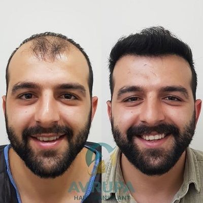 1 Year After Hair Transplant - Before & After Photos