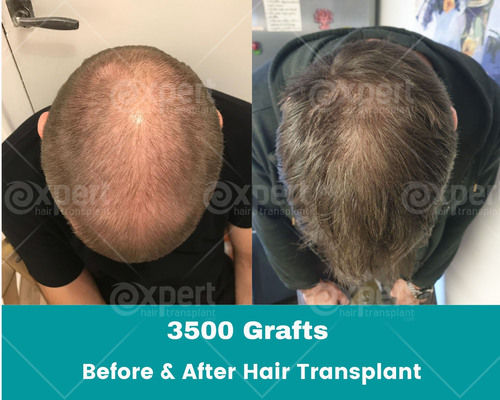 3500 Grafts Hair Transplant Case Study - Expert Hair Transplant