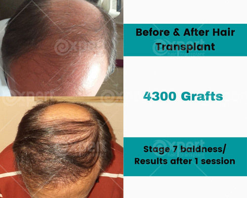 4300 Grafts Hair Transplant Case Study - Expert Hair Transplant