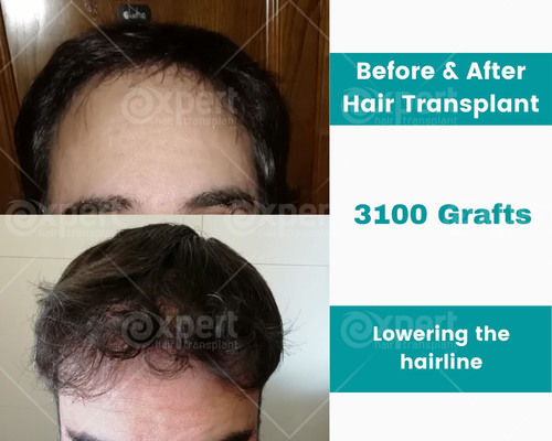 3100 Grafts Hair Transplant Case Study - Expert Hair Transplant