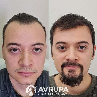 Hairline and Goatee Transplant Results