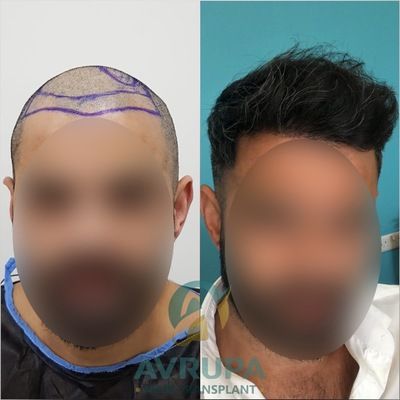 Hair Transformation 5 months Post Hair Transplant in Istanbul