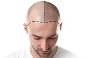 hair transplant Istanbul