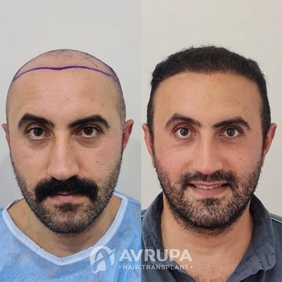 Before and After Hair Transplant - 4450 Grafts