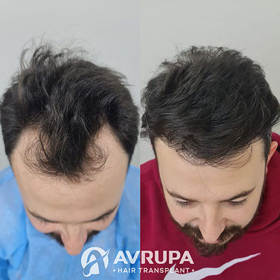 10 Months After Hair Transplant - 3500 Grafts