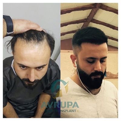 Male Hairline Lowering - 2800 Grafts Hair Transplant