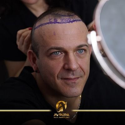 Celebrity Hair Transplant in Turkiye - Popular Italian Chef