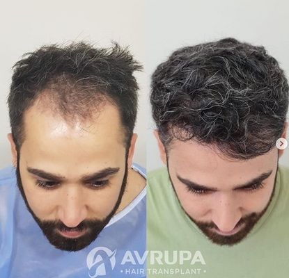 Hairline Lowering Results - 4150 Grafts