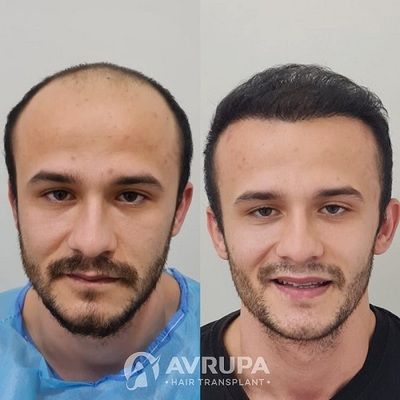 Hair Transplant Results After 9 Months - 4500 Grafts