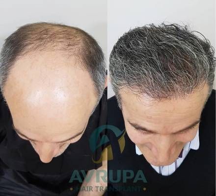 Hair Transplant Photos Before and After Transplanting 4800 Grafts