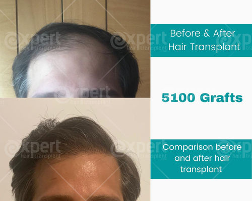 5100 Grafts Hair Transplant Case Study - Expert Hair Transplant