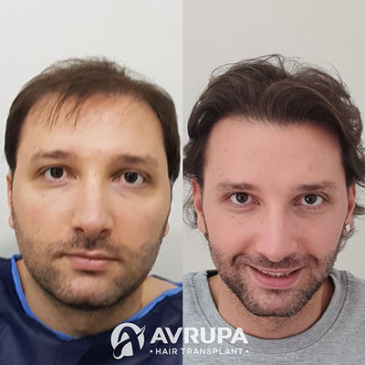 Hair Transplant Results After 2 Sessions with a Total of 7000 Grafts