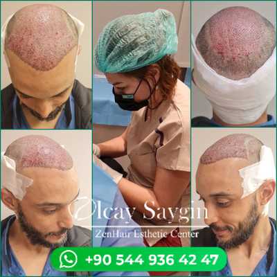 Photos from _ Dr. Olcay Saygin hair transplant clinic