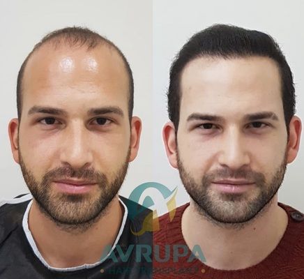 Male Hair Transplant Results After 9 Months - 4500 Grafts