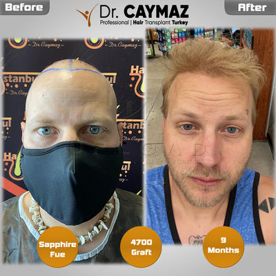 Dr. Erkam CAYMAZ - Hair Upload Clinic Before After Results