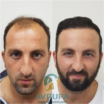 Hair Transplant Result of 4700 hair follicles at Avrupa Sac Ekimi Clinic