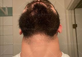 Minoxidil for Beard Growth